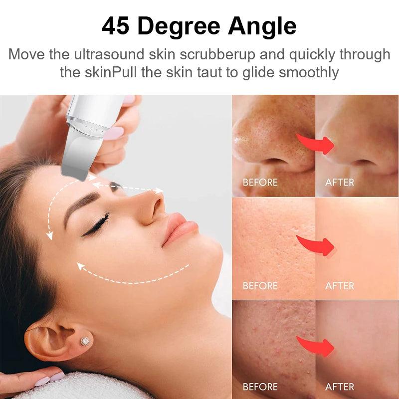 ULTRASONIC PORE EXTRACTOR - BeautifyFit