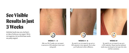 IPL LASER HAIR REMOVAL WITH COOLING - BeautifyFit